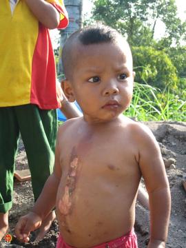 Seorang bocah laki-laki warga Kaligatuk, Srimulyo, Piyungan, Bantul terluka dari dada sampai pusa...
